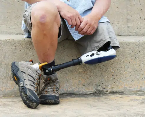 A close up look of the lower body with a Prosthetic leg sitting on the steps